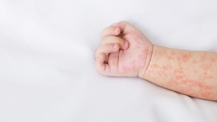 Kasus Campak Kaltim Meningkat, Suspek Terbanyak dari Samarinda dan Kutim