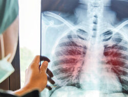 Indonesia Pengidap TBC Terbesar Kedua di Dunia, Ini Upaya Eliminasinya