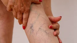 Varises Tak Boleh Diremehkan, Dokter RSUD AWS Samarinda Jelaskan Bahayanya